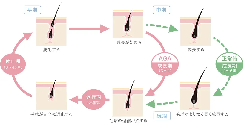 AGAの原因図