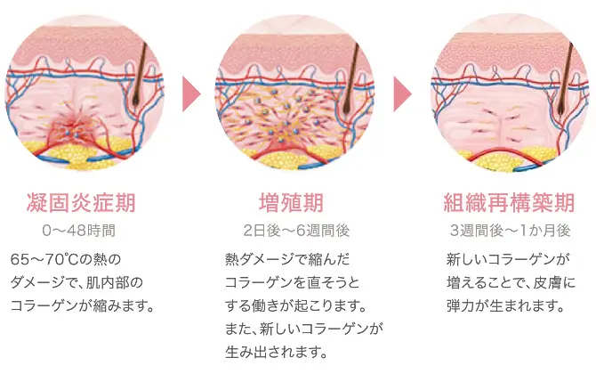凝固炎症期、増殖期、組織再構築期