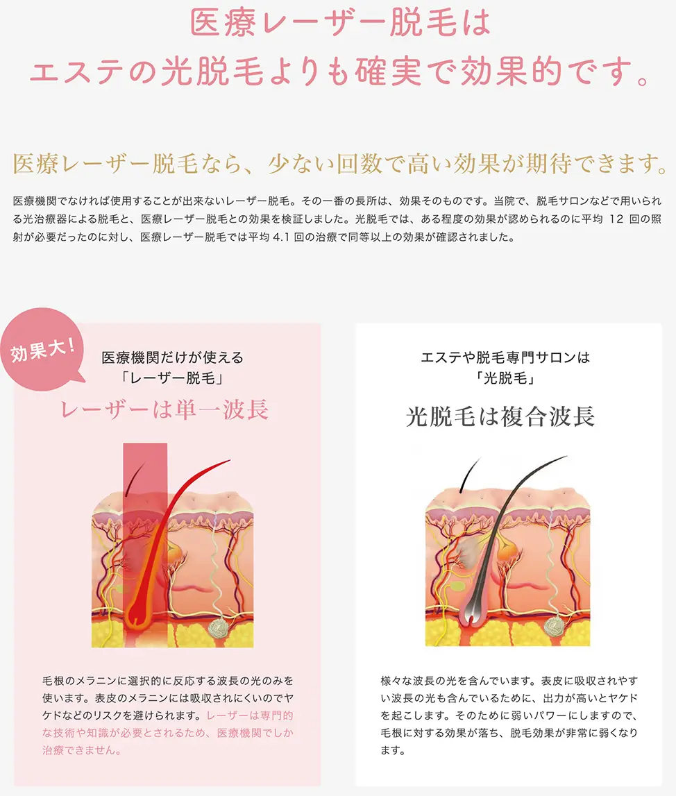 医療レーザ−脱毛は、エステの光脱毛より確実で効果的です。